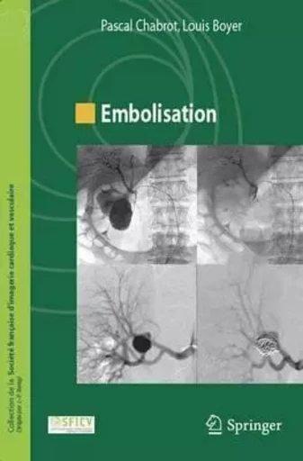 Embolisation - Pascal Chabrot, Louis Boyer - SPRINGER PARIS