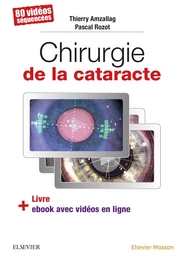 Chirurgie de la cataracte