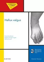 Hallux valgus