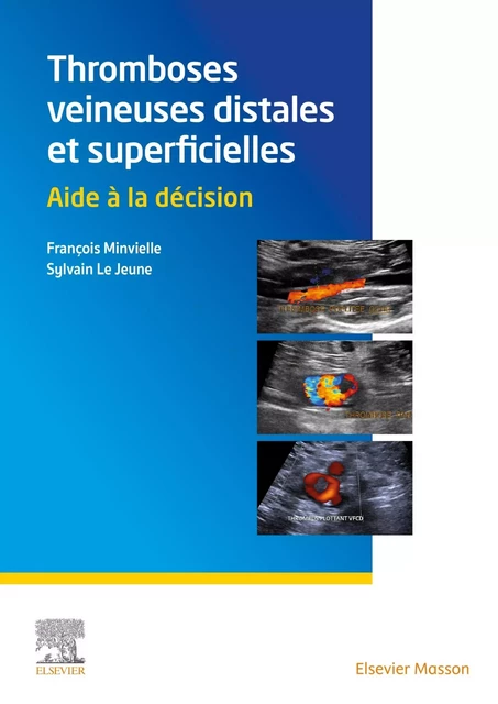 Thromboses veineuses distales et superficielles - François Minvielle, Sylvain Le Jeune - MASSON