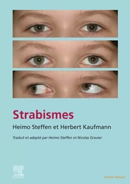 Strabisme