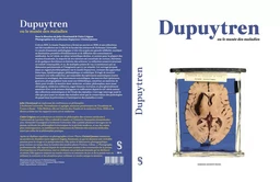 Dupuytren 