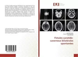 Fistules carotido-caverneux bilatérales spontanées