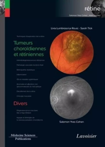 Tumeurs choroïdiennes et rétiniennes / Divers (volume 8 - coffret Rétine) - Salomon-Yves COHEN, Sarah TICK, ROUIC Livia LUMBROSO-LE - MEDECINE SCIENC