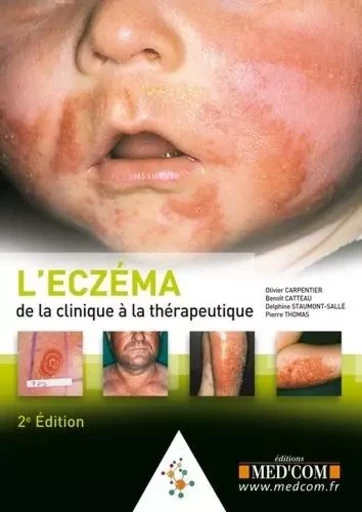 L ECZEMA. DE LA CLINIQUE AU TRAITEMENT. 2  ED -  CARPENTIER & CO - MED COM