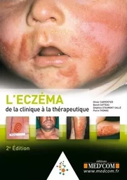 L ECZEMA. DE LA CLINIQUE AU TRAITEMENT. 2  ED