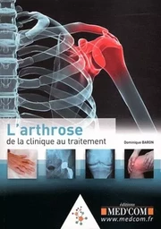 L'ARTHROSE : DE LA CLINIQUE AU TRAITEMENT